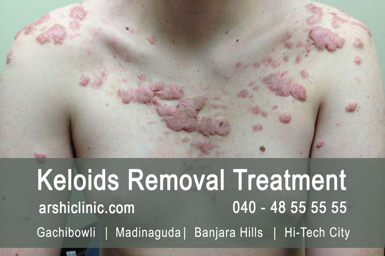 Keloids Removal Treatment