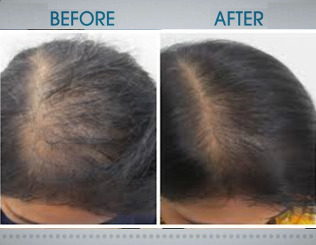 Hair Growth treatment in hyderabad