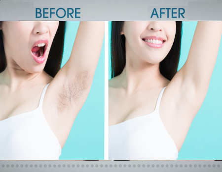 hair removal