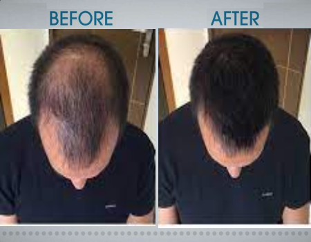 Hair Growth treatment