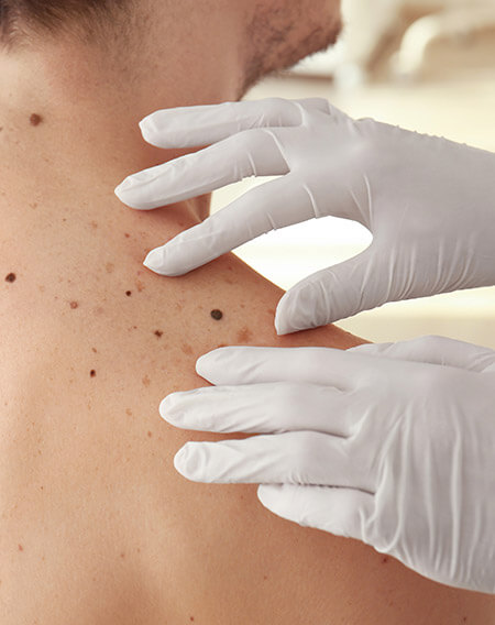 mole removal treatment