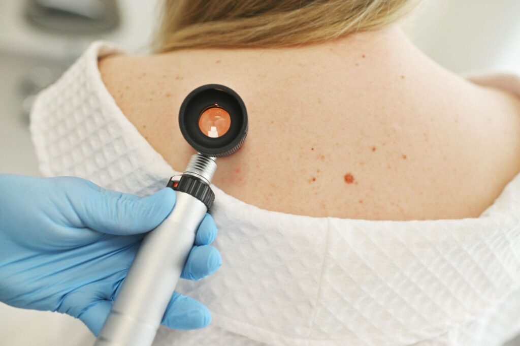 Comprehensive Skin Cancer Screening in Hyderabad to detect suspicious moles and protect your long-term skin health.