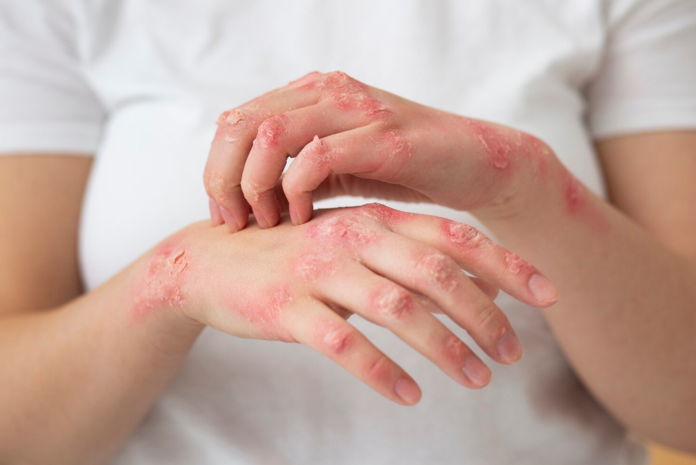 Biologic treatment for psoriasis